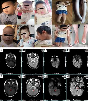Characteristics of Allan-Herndon-Dudley Syndrome in Chinese children: Identification of two novel pathogenic variants of the SLC16A2 gene